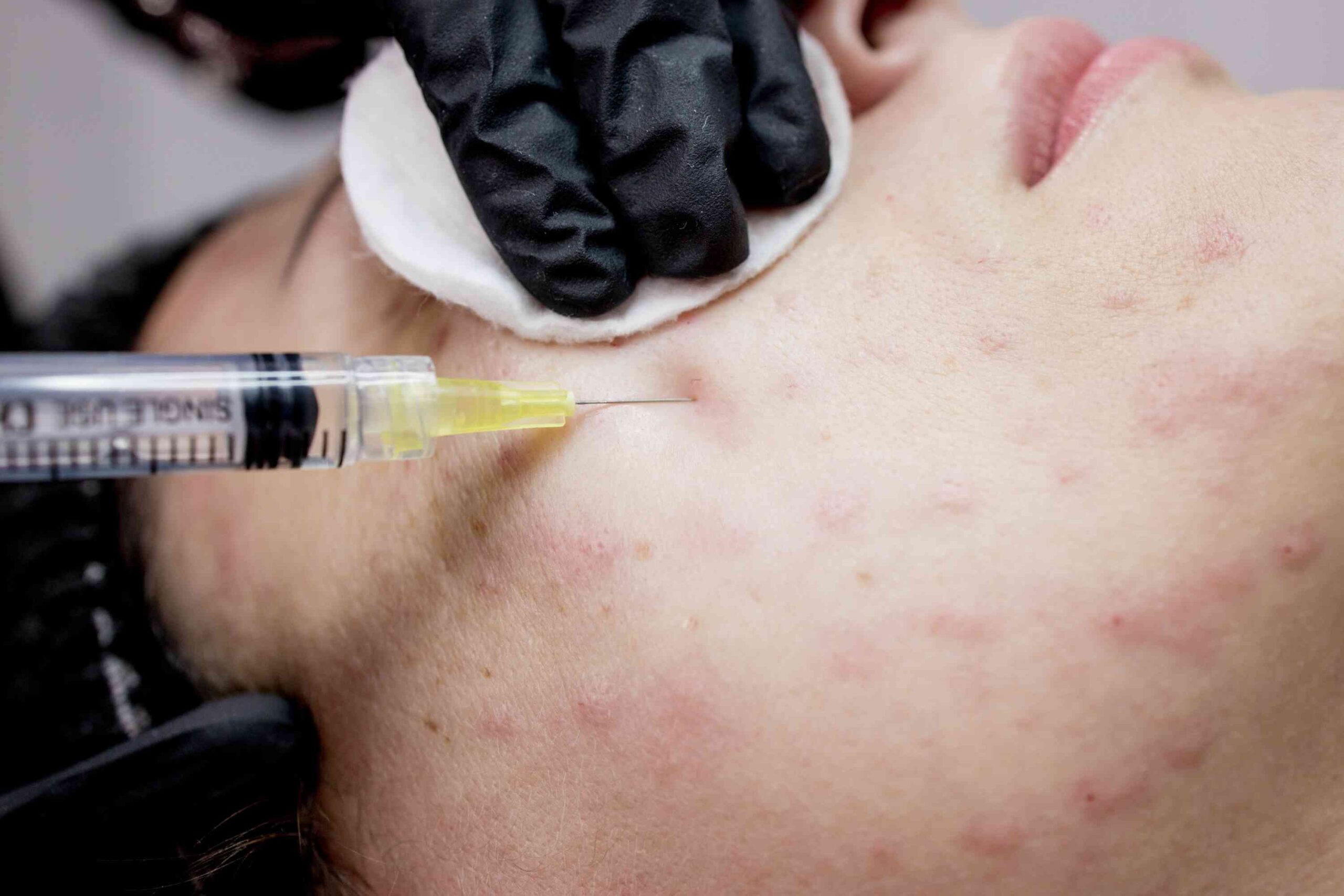 Skin Booster Mesotherapy