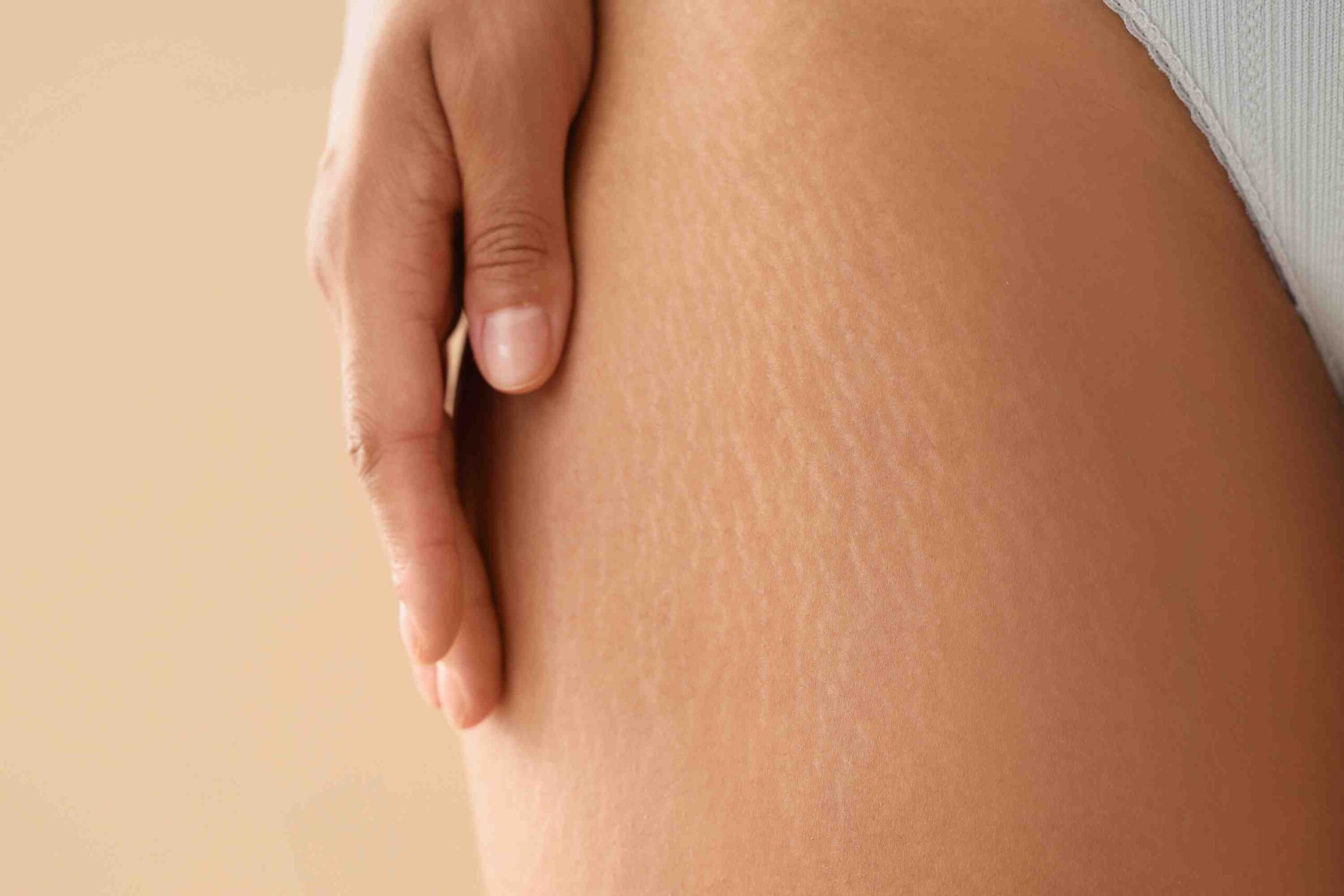 laser stretch marks
