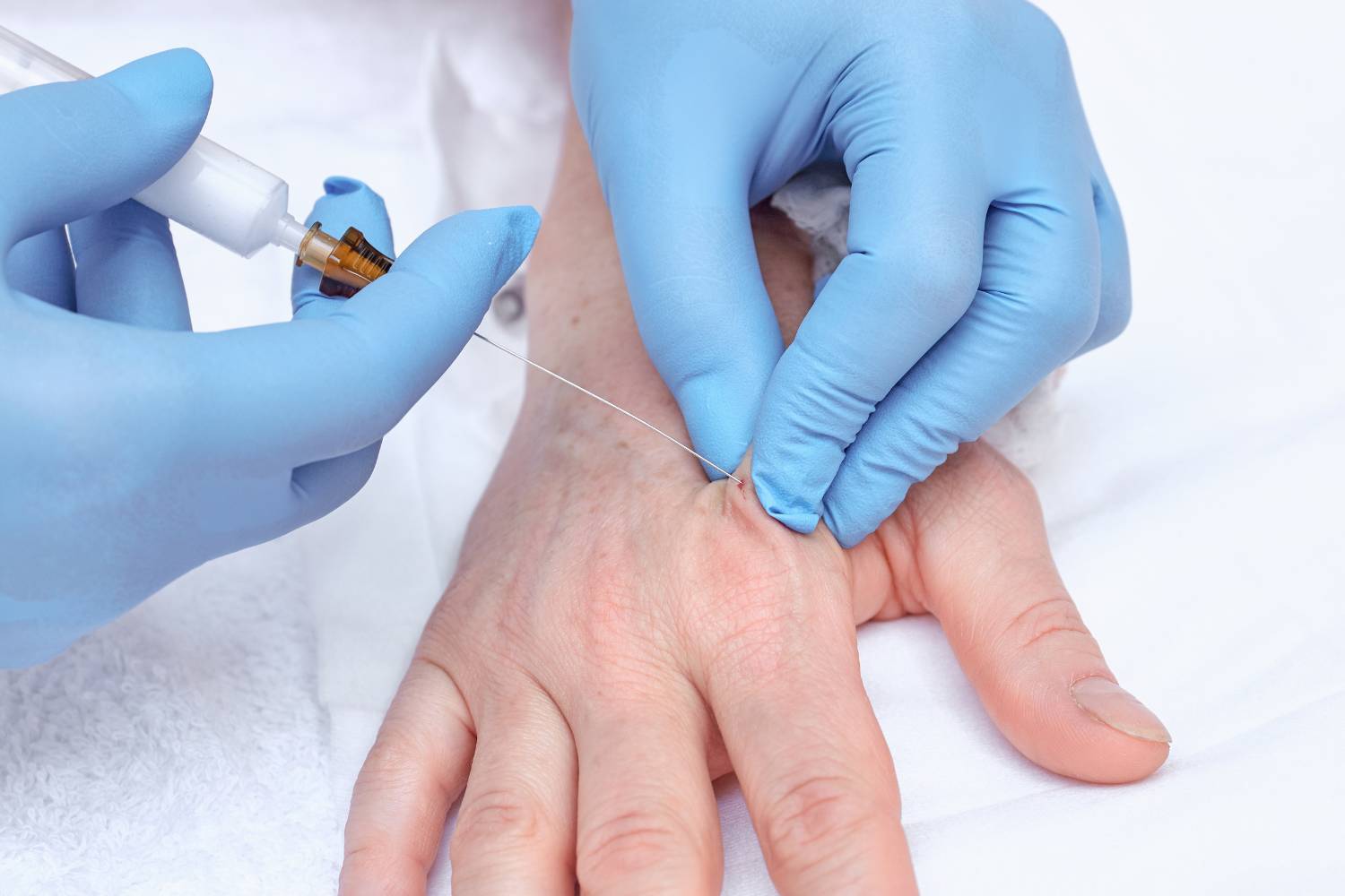 How to Maintain Hand Rejuvenation Results Longer: Tips for Lasting Youthful Skin