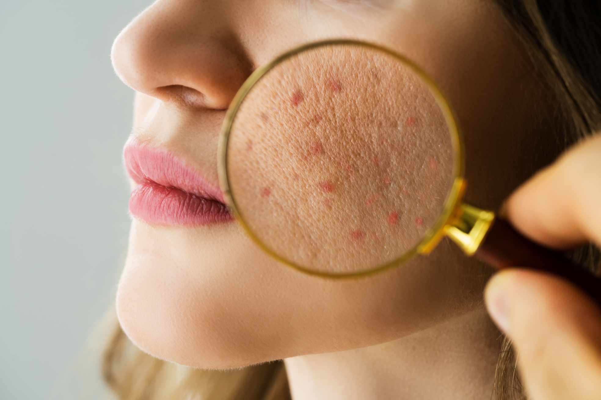 Acne Scar Treatments Ranked: From Mildest to Most Effective