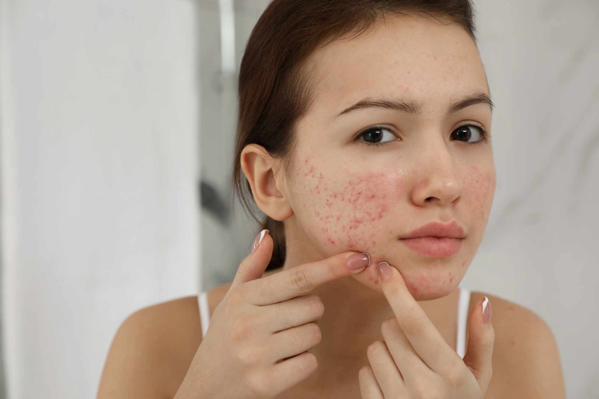 Hormonal Acne in Adults: Why It Happens and How Clinics Can Help