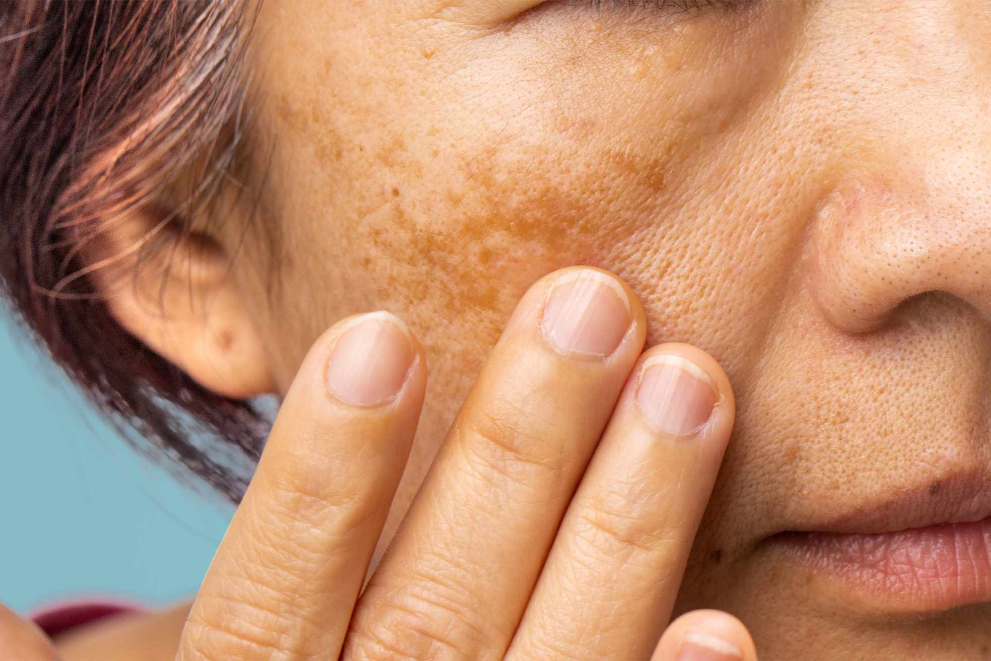 Melasma Treatment in Australia: What Actually Works