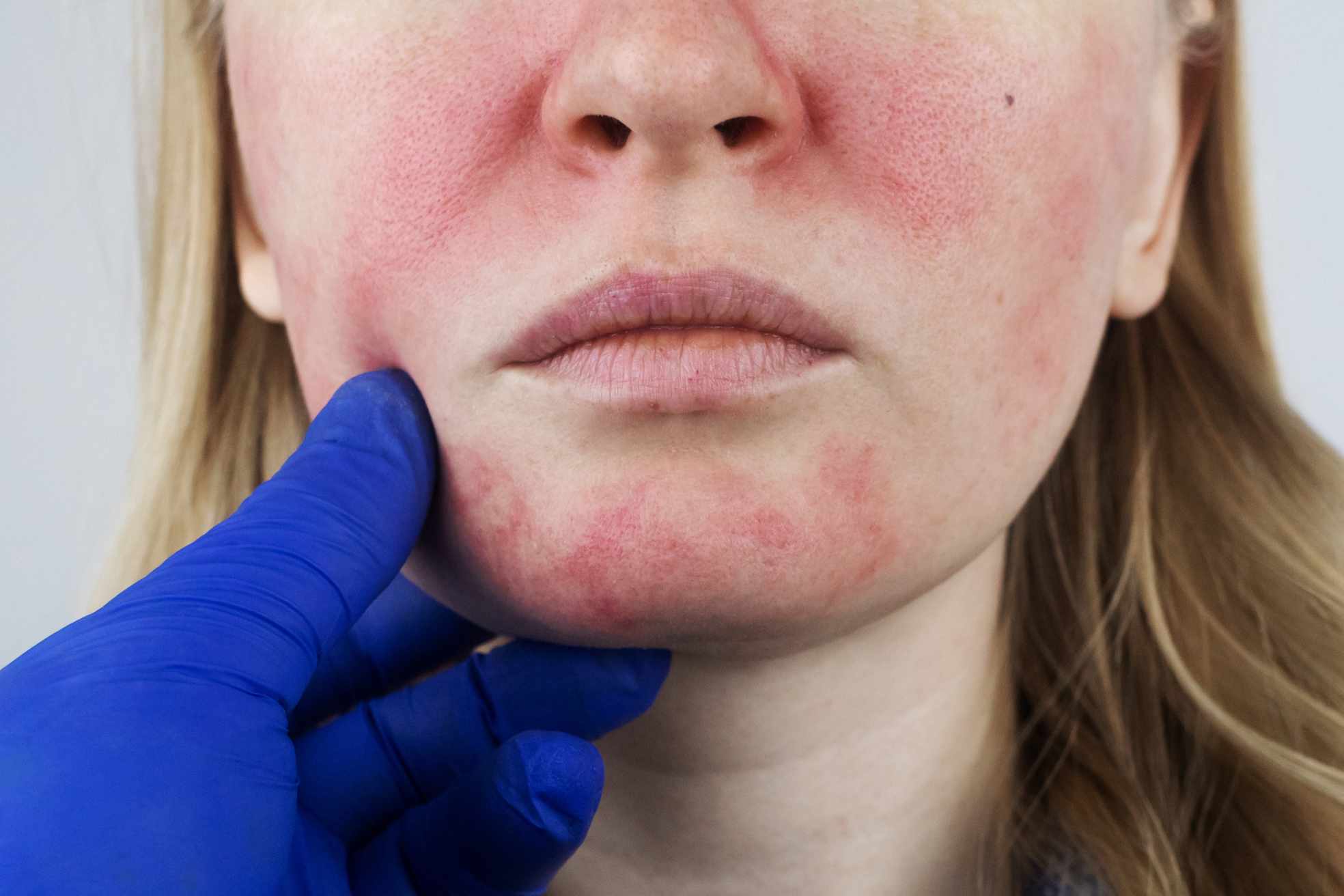 Rosacea Explained: Causes, Triggers and Clinical Treatments